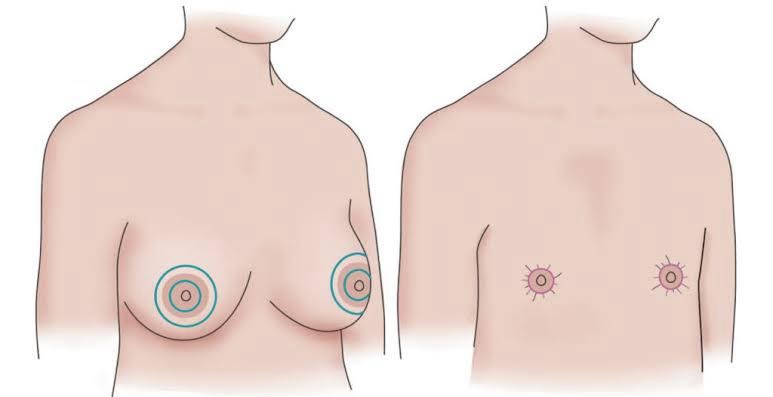 Mastectomia para Pessoas Trans: Um Passo Importante na Jornada de Afirmação de Gênero